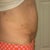 10 days after MTT