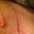 biodermis reaction??? and incision.