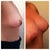 Before and 2nd day post op