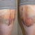 Bruises, about 4 days post-op