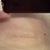 post-op day 45, scar...just a straight line, very flat, not dark at all, picture taken is the mirror image of the scar