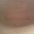 post-op day 45, picture taken of the actual scar, no mirror used