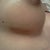 post-op day 45, scar, no mirror. the shadow you see is not discoloration or bruise but the mark of the scaraway strip i just pulled out from the incision site, it's some kind of silicone adhesive stuff so it leaves a bit of a mark.