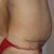 One year after surgery, I still have so much skin on the front and the scars are protruding, including my tinny and worm-looking belly button.  There are no lipo entry wounds on the back or areas where they suppose to be. I feel cheated.
