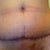 2 1/2 wks- Closer shot of scabbing incision.
