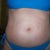 Before, LOTS OF STRETCH MARKS!