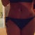 1 week post op. Still have some stretch marks below belly button, but not nearly as many!!