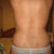 This is 4 weeks post-op