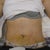 5 days post op at the PS office