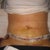 5 days post op.  Later that evening, more swelling but I really love the results.