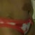 The other side, this scar is not so high but you can see the dog ear on my right side.