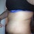 This is my left side at POD 19.  This side is really swollen, but there is not a seroma there at this time.   It just looks weird!
