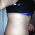This is my right side at POD 19.  I am a lot more happy with the shape fo this side of my body at this point, but there is still a huge amount of swelling.