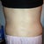 And, here is a back picture.  I had lipo of my flanks, and I alm still pretty swollen back here, but I can see a little bit of shape.  My torso used to look like a box from the back... so there's a little improvement!