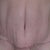 8 wk postop