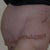 6 days postop- looking a little PG -LOL
