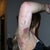 2 days after arm surgery