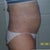 3 months after surgery
