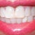 My teeth before Invisalign.  Using a bottom tooth veneer to give the illusion of straighter teeth.  Others on lower R also misaligned. Slight bunching of front teeth over side ones.