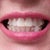 Removal of lower veneer. Shaved teeth to accelerate movement with Invisalign. Now they look uneven. This made them slightly more unsightly. Unexpected aligner buttons!