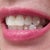 Very visible aligner buttons all over my teeth! Changing the color would not help. They need clear composite.