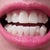 Removal of problematic back teeth.  OMG, they shaved my front teeth uneven to allow movement. Visible aligner buttons, without Invisalign tray on.