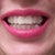 Invisalign trays on.  White composite filling was added to Invisalign tray were missing teeth are, until I get the implants.