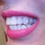 Side view showing my natural teeth.  Not too misaligned but slightly.  The worst is the aligner buttons.