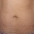 my hysterectomy scars...1 on left,1 on right,1 down my belly button...all above my c-section scar & above my undies...tummy tuck should get rid of these.