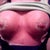 AFTER: Breast Day 5 (cellphone photo)