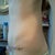 Day 15-side Looking more normal! YEAH!