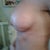 left breast 10 days posy-op. I have a strange indentation from nipple out. It comes and goes?