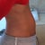 Side - 5 days after procedure - mostly representative of "before"