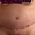 14 days post op