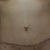Scar at 6 months post op