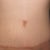 Scar at 10 months post op.
