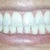 3 months post after cosmetic bonding to lengthen 4 uppers