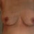week (almost) 5  scabs are gone- started the massage with bio oil...still a little sore but minor
