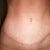 tummy tuck scar 2 months ( very happy with it thus far) just got done working out so have a bit of swelling in this pic