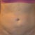 2wks out front-still swollen & a lil hard/lumpy now...