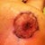 Right nipple, 13 days post-op.