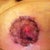 Left nipple, 13 days post-op.