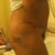 Post Op Day 4 Right Side
