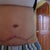 8 days post op