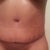 Just seen I have not posted an incision pic.