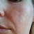 7 weeks after 2nd treatment left cheek