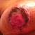 Day 14 Right nipple after some necrotic tissue removed. Barely noticable.