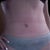 10 weeks PostOp front view.