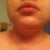 My chin :( hoping it looks better after surgery