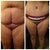 Here is a before and after (3 weeks post op) I'm thrilled!